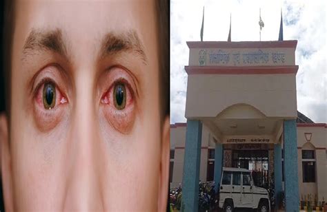 Eye flu cases in Chhattisgarh: Eye flu is spreading rapidly in Surguja