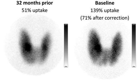 Thyroid Scan And Uptake