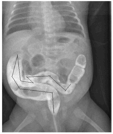 Can Infant Dyschezia Be a Suspect of Rectosigmoid Redundancy?