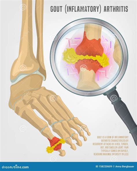 Gout Arthritis Infographic. Vector Illustration | CartoonDealer.com #159083450