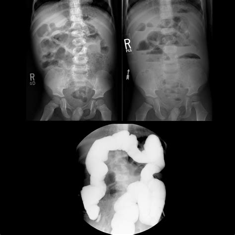 Preschooler with cystic fibrosis and abdominal pain | Pediatric Radiology Case | Pediatric ...