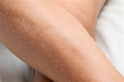 Why Your Skin Is Always Dry: Dry Skin Barrier Damage & How To Fix It ...