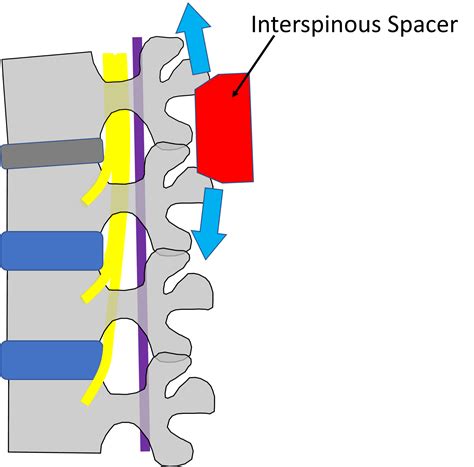 Interspinous Spacers: The Best Thing Since Sliced Bread or a Bad Idea? - Regenexx