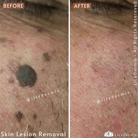 Seborrheic Keratosis Treatment
