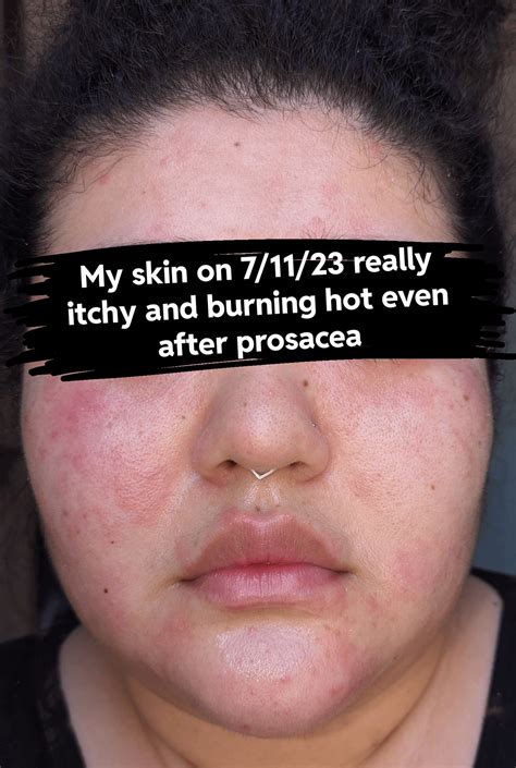What has helped your guys papulopustular rosacea? : r/Rosacea