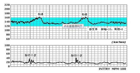 胎心监护异常案例分享（不同的结局，让人唏嘘）|胎心|监护|缺氧_新浪新闻