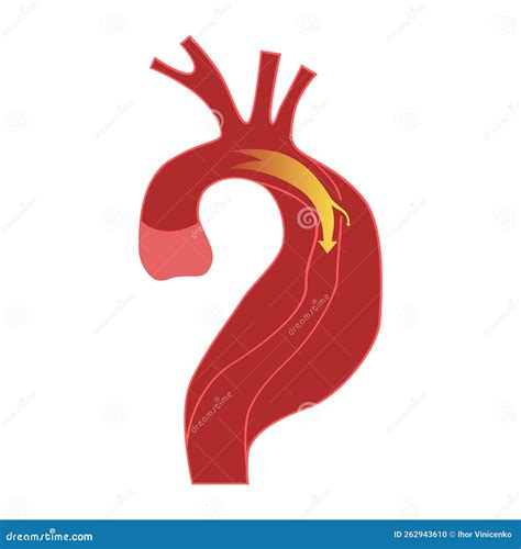 Balloon Aortic Valvuloplasty Or BAV. The Balloon Catheter Is Advanced. Aortic Stenosis, Or ...