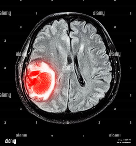 What Does A Brain Tumor Look Like On An Mri Scan?