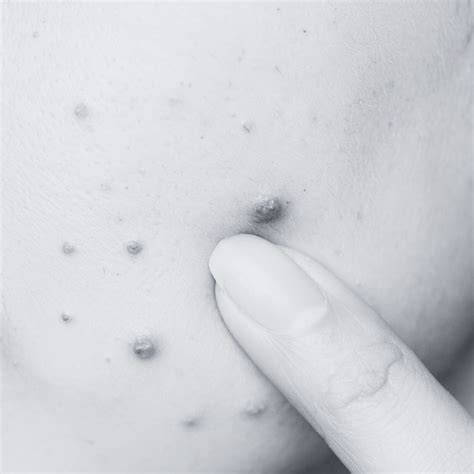 ACNE PRONE SKIN | Discover Essential Care Tips and Treatments – SECRET ...