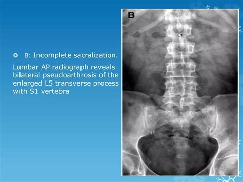Transitional vertebrae radiology | PPTX
