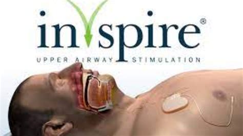 Inspire Sleep Device: A Breath of Fresh Air for Sleep Apnea