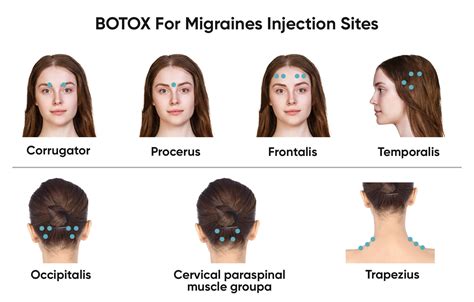 I got Botox for Migraines — By Mandy Maltz