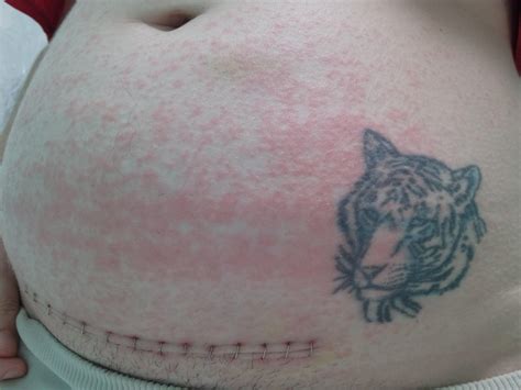 Itchy Rash After C Section at Wendell Blakely blog