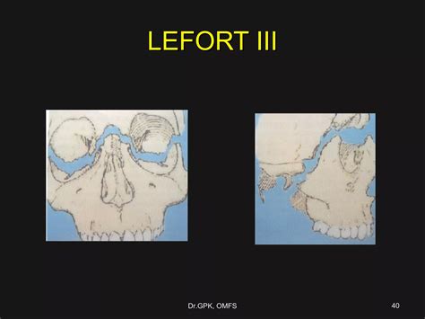 Le fort fractures | PPT