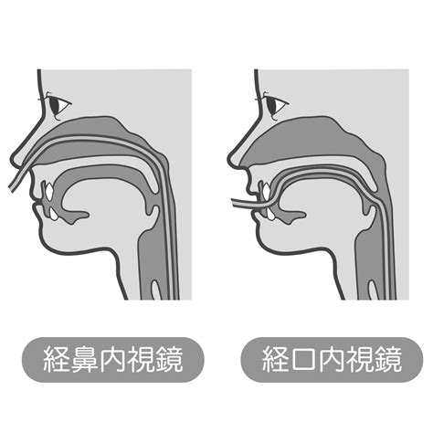 経鼻内視鏡と経口内視鏡の通り道のイラスト🎨【フリー素材】｜看護roo![カンゴルー]