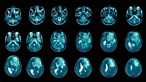 Brain Mri Tumor
