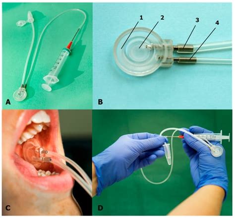 Unstimulated Parotid Saliva Sampling in Juvenile Idiopathic Arthritis ...
