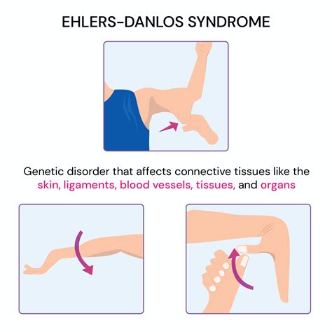 Ehlers Danlos Syndrome & The Eyes