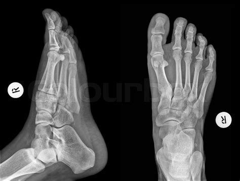 Xray Of Normal Foot