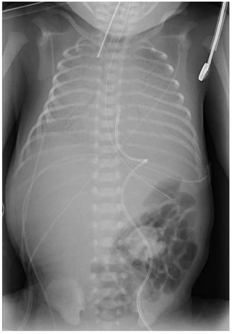 Persistent Right Umbilical Vein: Clinical Case and Literature Review
