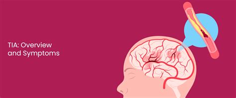 Understanding TIA : Overview and Symptoms - TriLife Hospital