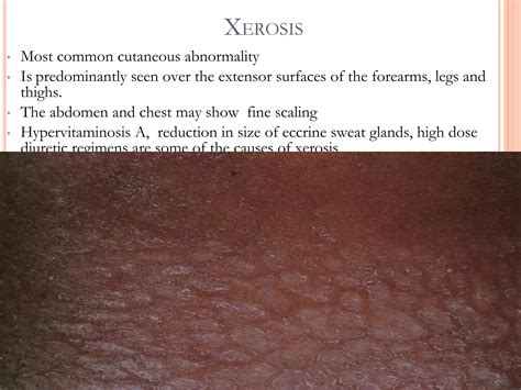 Causes Of Xerosis