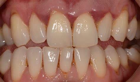Possible Reasons for a Receding Gum Line - Balsall Common Dental