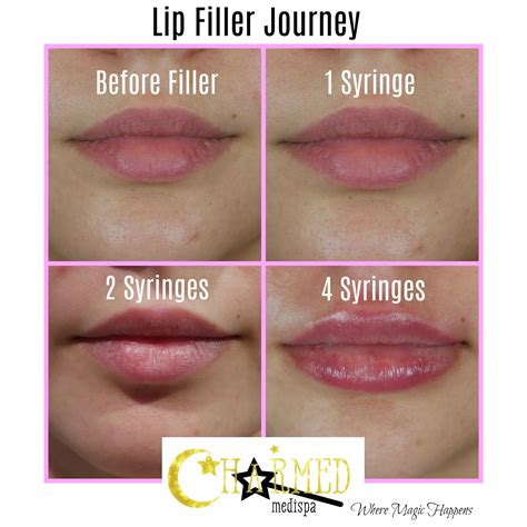 Juvederm Lips Fillers For Lips In New Jersey | SOMA Skin & Laser