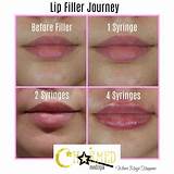 What Does 1Ml Lip Filler Look Like at Angel Santucci blog