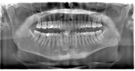 Somewhat confirmed Eagle Syndrome, would love your opinions - General - Living with Eagle