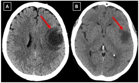 Tumefactive Demyelinating Lesion Mimicking Low-Grade Astrocytoma with a ...