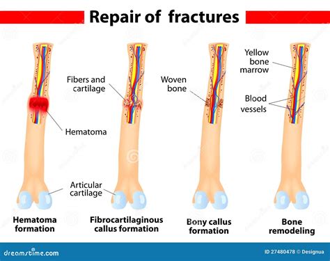 Image result for Bone Healing Process
