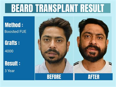 How much does a beard transplant cost India?