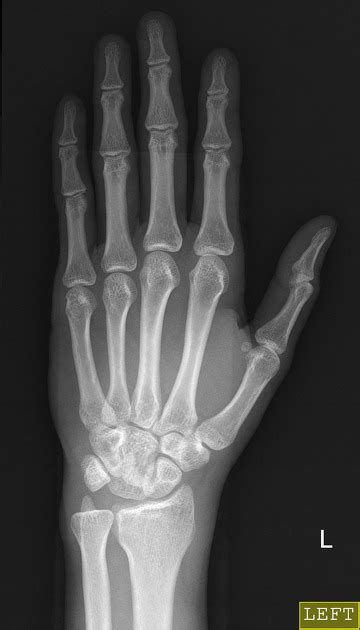 Image result for Lunate Dislocation Reduction