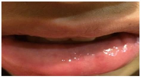 Excision of Lower Lip Mucocele Using Injection of Hydrocolloid Dental Impression Material in a ...