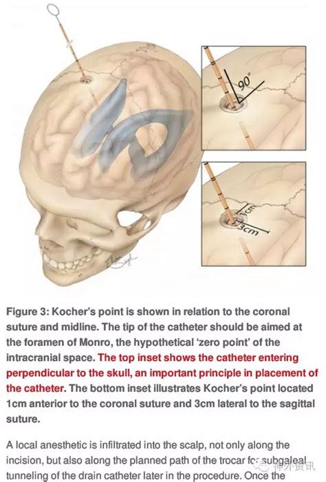 脑室外引流的操作技巧| The Neurosurgical Atlas系列