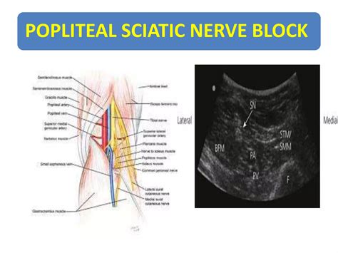 Usg r nerve block | PPTX