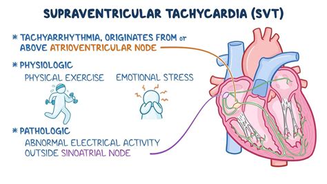 Supraventricular tachycardia: Video & Meaning | Osmosis