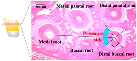 Micro-Osteoperforations Accelerate Orthodontic Tooth Movement without ...