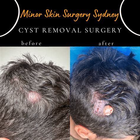 Cyst Surgery, Cyst Removal, Cyst Treatment Sydney