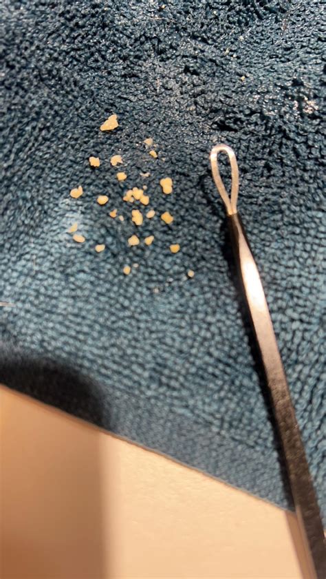 Tonsil Stones, Severe Ear Pain : r/tonsilstones