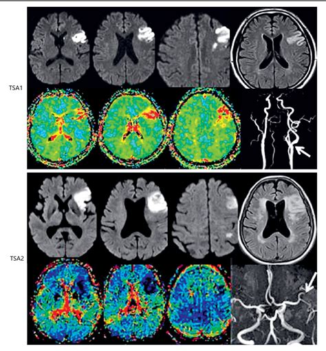 Figure 1 from Transcortical Sensory Aphasia after Left Frontal Lobe ...