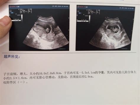 孕8周，好好的「胎芽」突然不見了？「胎停育」的這些信息要清楚 - 壹讀