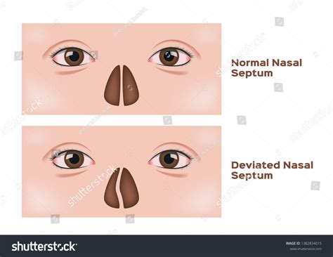 58 Deviated Nasal Septum Surgery Images, Stock Photos & Vectors | Shutterstock