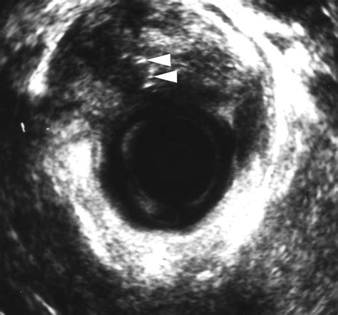 Rectovaginal Fistula Ultrasound