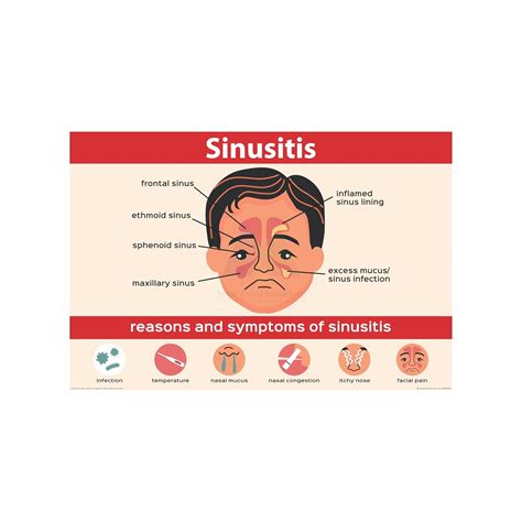 Anne Print Solutions® sinusitis chart Posters Without Frame Hospital ...