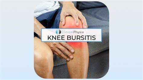 Knee Bursitis – Clinical Physio Membership
