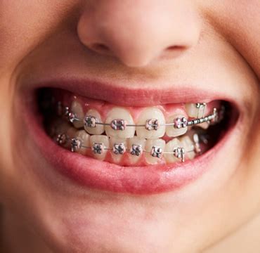 Invisalign treatment in Madipakkam | Best orthodontist in nanganalur