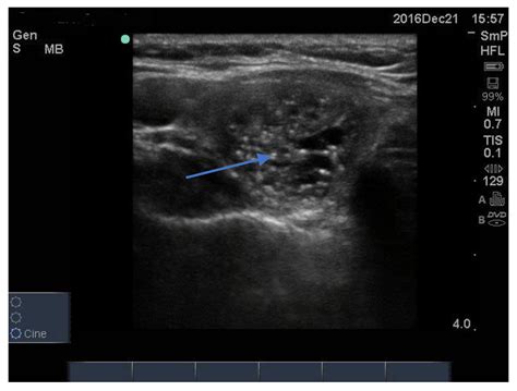 Thyroid Cancer Ultrasound