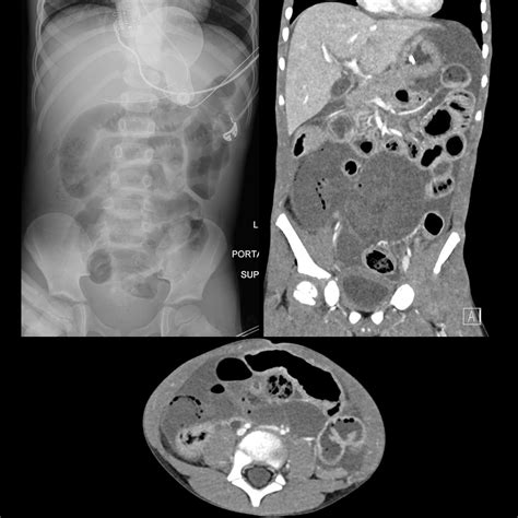 Meckel Diverticulum Xray Intestinal Obstruction Caused By Torsed
